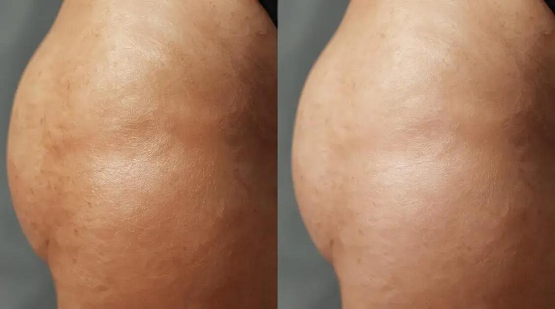 Carboxiterapia resultado: o que esperar do tratamento estético no Brasil?