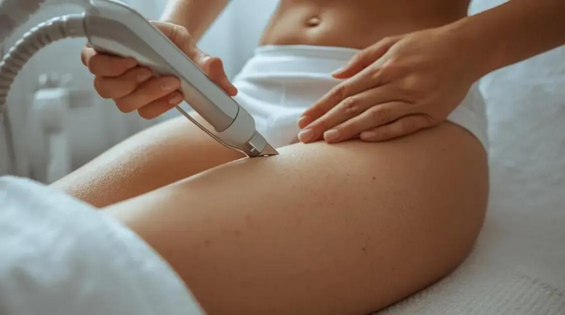 Celulite grau 3 tratamento estético: soluções avançadas para resultados reais