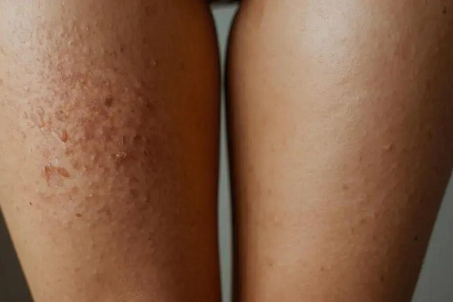 Como acabar com a celulite: estratégias eficazes para uma pele mais lisa