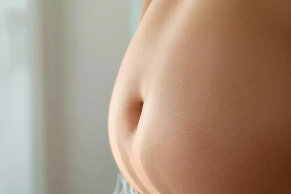 Estrias na barriga tratamento: descubra as opções eficazes e diga adeus de vez